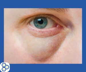 Your eyes can show you signs of gallstone issues.