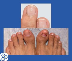 Your nails and toes can be telling you to correct liver issues.