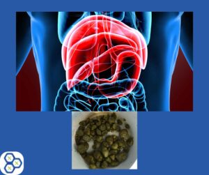 Read more about the article Signs and symptoms of gallstones causing health issues