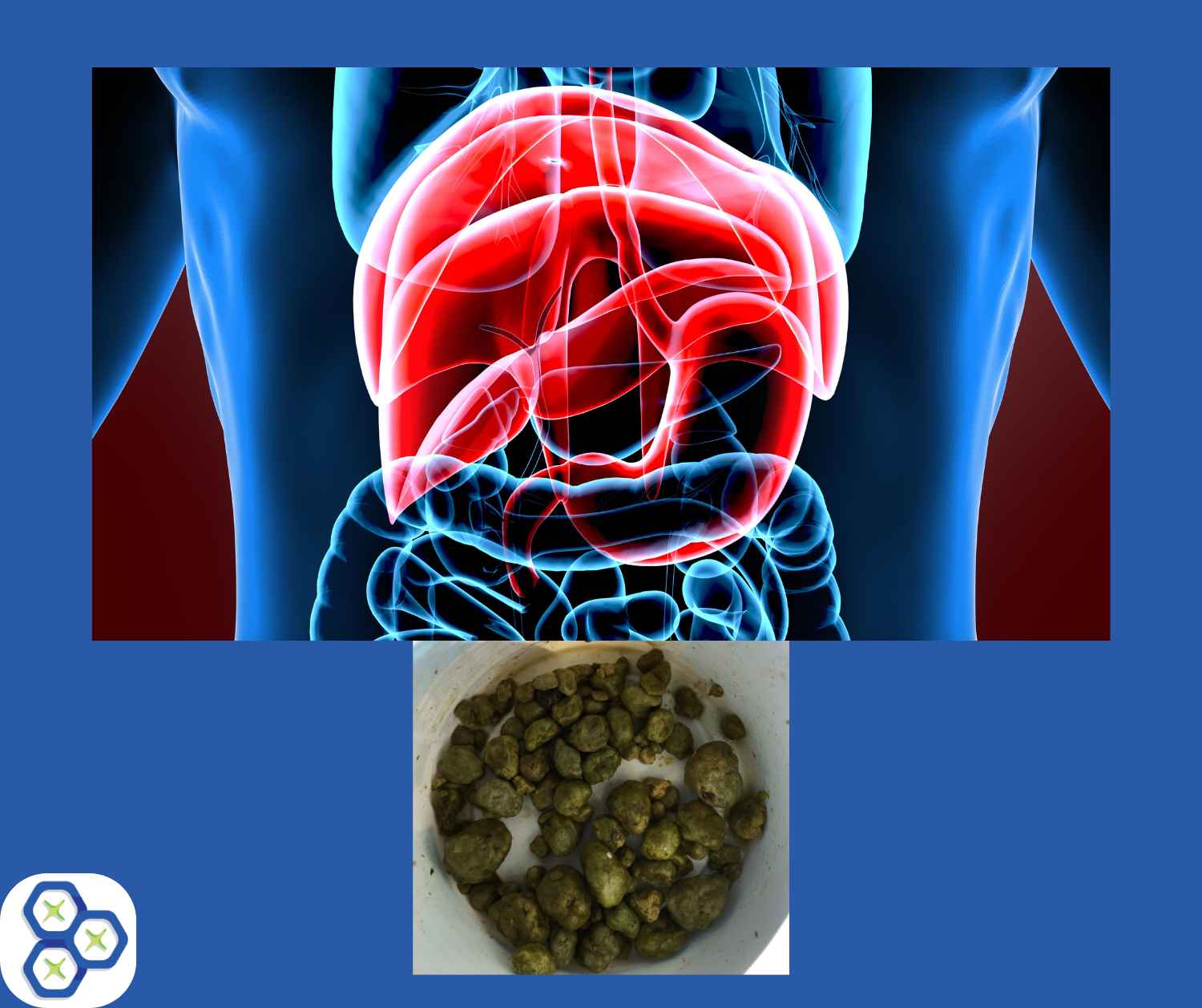 You are currently viewing Signs and symptoms of gallstones causing health issues