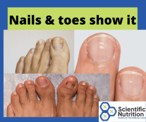 Your nails and toes can be telling you to correct liver issues.