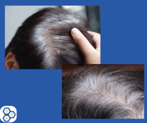Read more about the article Trauma Causes Gray Hair: Mineral Depletion Link Revealed [New Research]